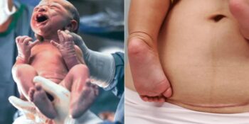 Tıp Merkezlerinde Planlı Sezaryen Yasaklandı: Peki Bu Ne Anlama Geliyor, Uzmanlar Ne Diyor?