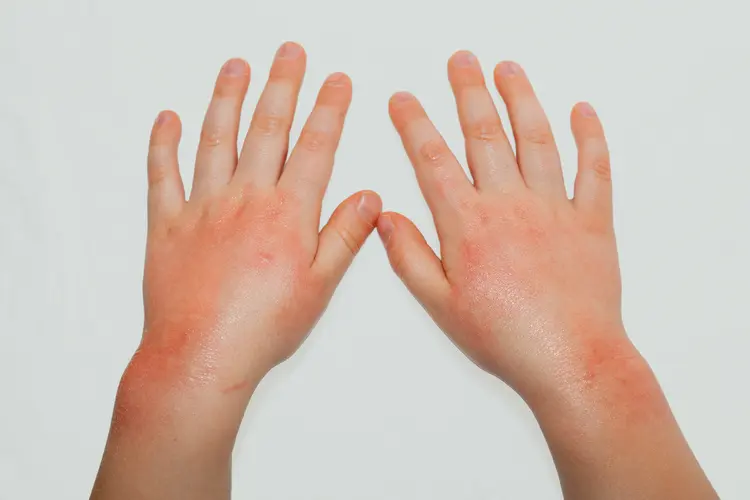 atopik dermatit kaşıntısını geçirmek