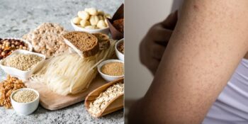 Saç Dökülmesinden Cilt Sorunlarına: Glüten Hassasiyetinizin Olduğunu Gösteren 13 İşaret