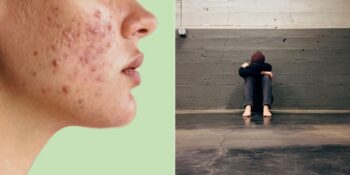 Kilo Artışı, Sivilce, Yorgunluk: Vücudunuzda Kortizol Seviyesinin Yüksek Olduğunu Gösteren İşaretler ve Nedenleri