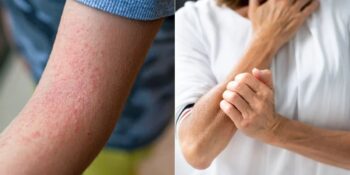 Kumaş Tercihinden Sıcak Havaya: Farkında Olmasanız Da Egzamanızı Kötüleştiren 8 Şey