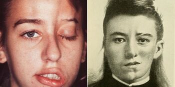 Taş Yiyenlerden Yüzü Eriyenlere: Modern Tıbbın Bile Çaresiz Kaldığı Dünyadaki En İlginç 6 Hastalık