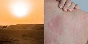 Sıcak Çarpmasından Böcek Isırıklarına: Yaz Aylarında Çok Sık Karşılaşılan 9 Sağlık Sorunu