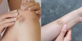 Bilim İnsanları Açıklıyor! Kadınların Vücudu Neden Erkeklerden Daha Kolay Morarıyor?