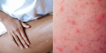 Kalçada Neden Sivilce Çıkar? Nasıl Tedavi Edilir?