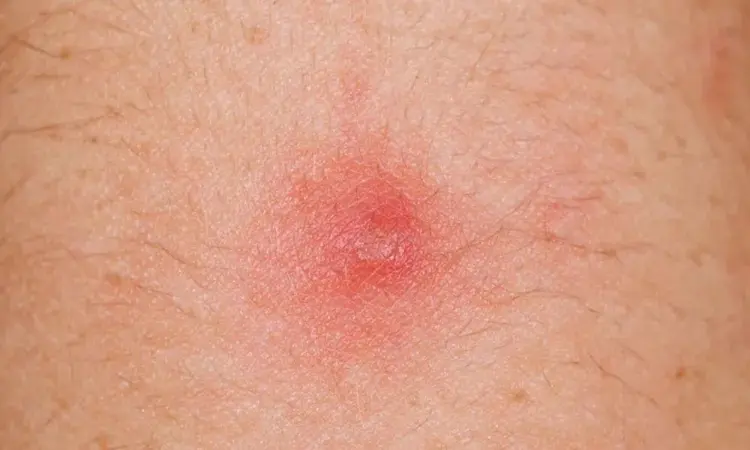 Popoda neden sivilce çıkar