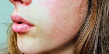 Yüzdeki Kiloyu Eritmek Mümkün mü? Yüzünüzün Daha İnce Görünmesini Sağlayacak 6 İpucu