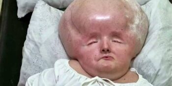 31 Yıldır Hidrosefali Hastalığıyla Mücadele Eden Graziely Alves Régis’in Hikayesi