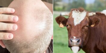 Güvercin Pisliğinden İnek Salyasına: Kelliğe Çözüm Bulmak İçin Denenmiş 10 Sıra Dışı Girişim