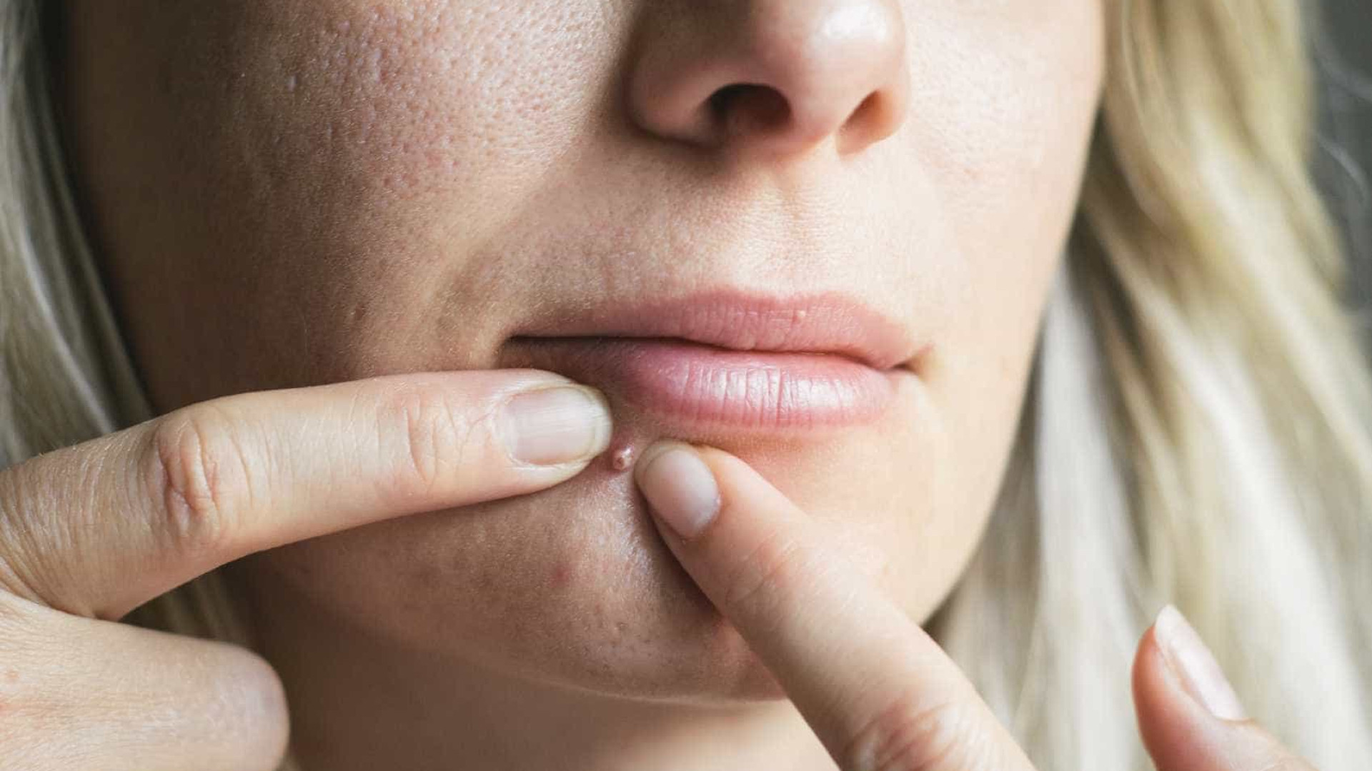 ölüm üçgeni sivilceleri